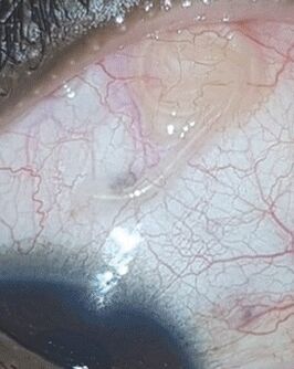 NEOflorax palīdzēja atbrīvoties no tārpa acī